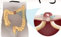 Stoma Location in Right and Left Iliac Fossa