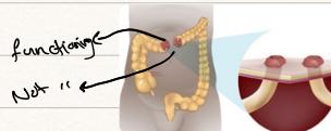 Loop Colostomy Diagram