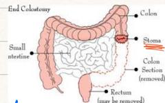 Double Barrel Colostomy Diagram