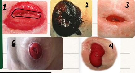 End Colostomy Diagram