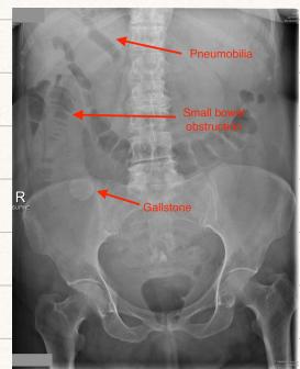 Abdominal Radiograph Pneumobilia Gallstone Ileus