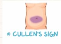Cullen's Sign Diagram