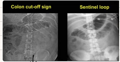 Colon Cut-off Sign and Sentinel Loop