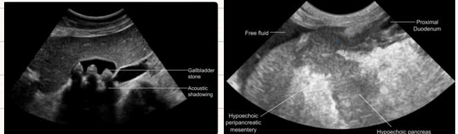 Ultrasound Gallstone and Pancreatic Edema