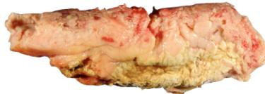 Resected Necrotic Pancreas Specimen