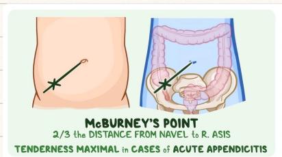 Appendicitis Surgical Specimen