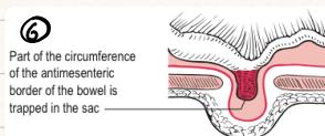 Richter's Hernia Diagram