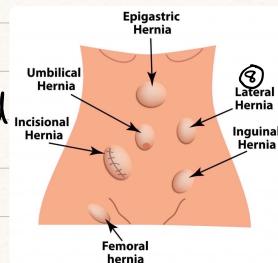 Abdominal Wall Hernia Types