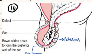 Sliding Hernia Cross-Section
