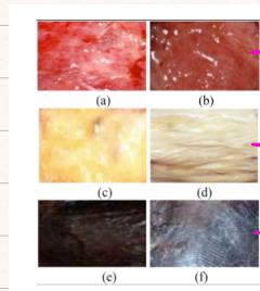 Clinical Skin Photos Lower Limb Ischemia