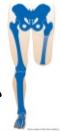 Transfemoral Above Knee Amputation