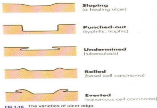 Ulcer Edge Types