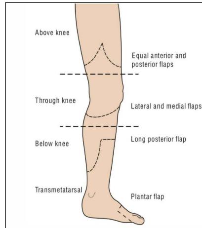 Amputation Levels and Skin Flaps