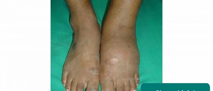 Charcot joint