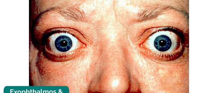 Exophthalmos & lid retraction