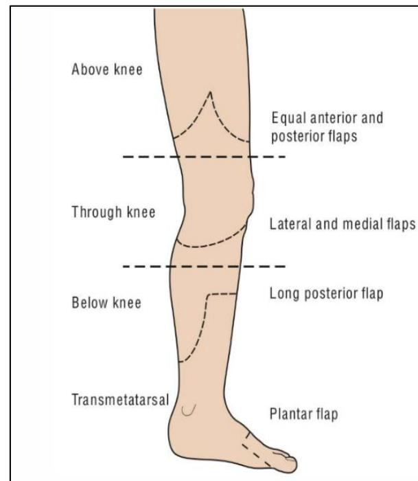 Flap Designs for Lower Limb Amputations