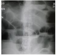 Small Bowel Coin Stack Appearance