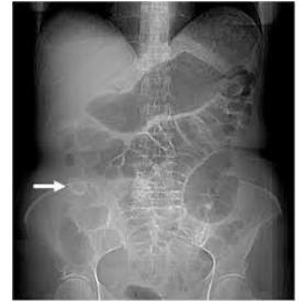 Abdominal X-Ray Gallstone Ileus
