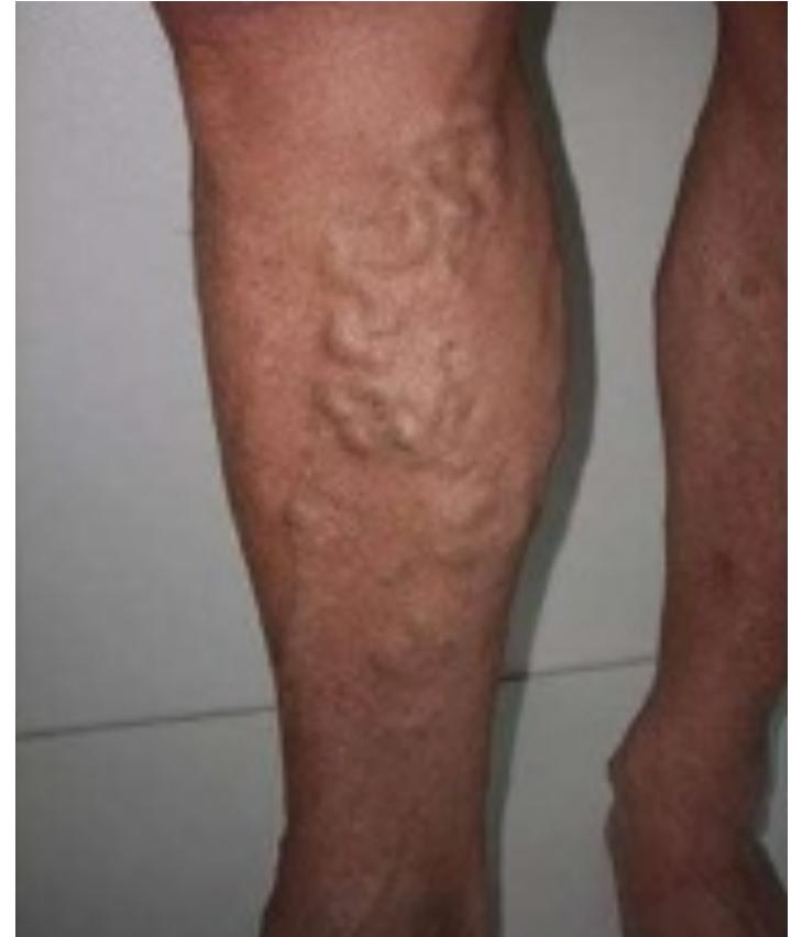Varicose Veins on Leg