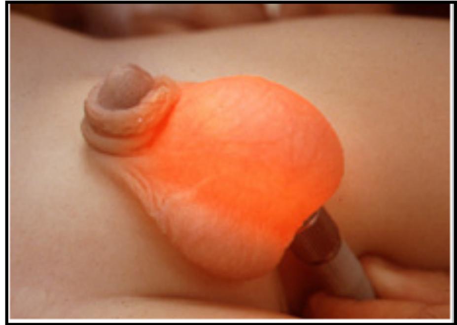 Scrotal Ultrasound Hydrocele