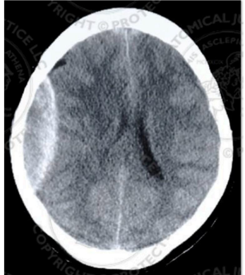 Axial Brain CT Epidural Hematoma