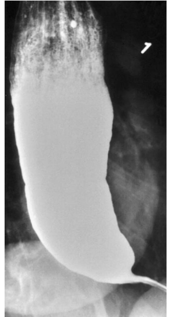 Dilated Esophagus Barium Swallow