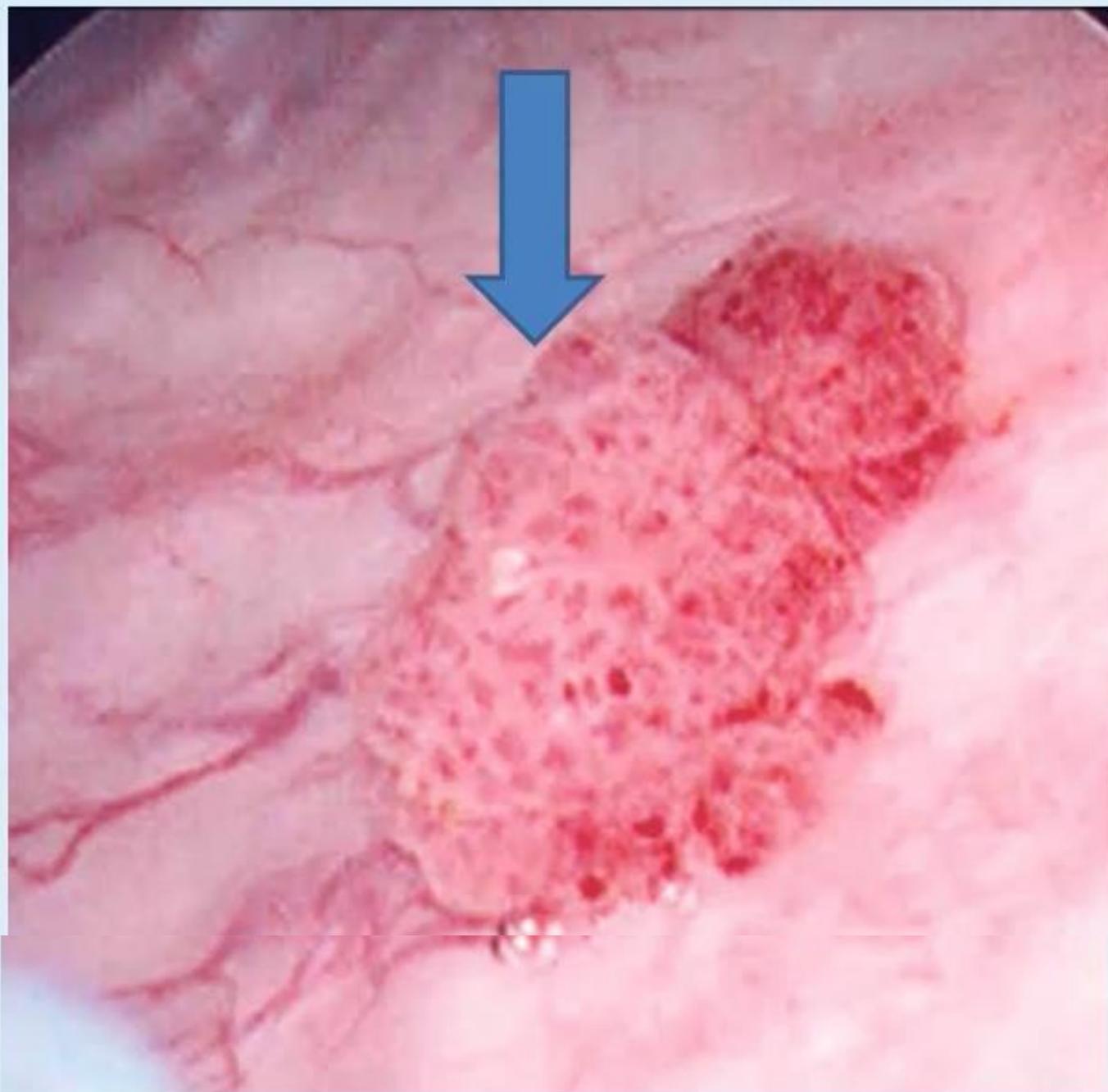 Cystoscopy Bladder Wall Lesion