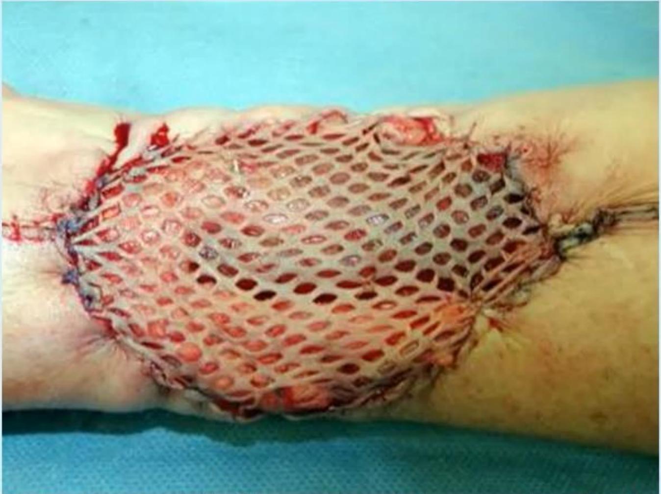 Forearm Burn Injury