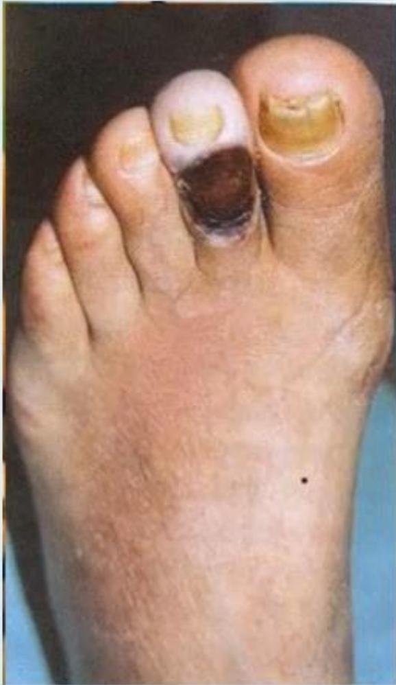 Human Foot Necrotic Lesion