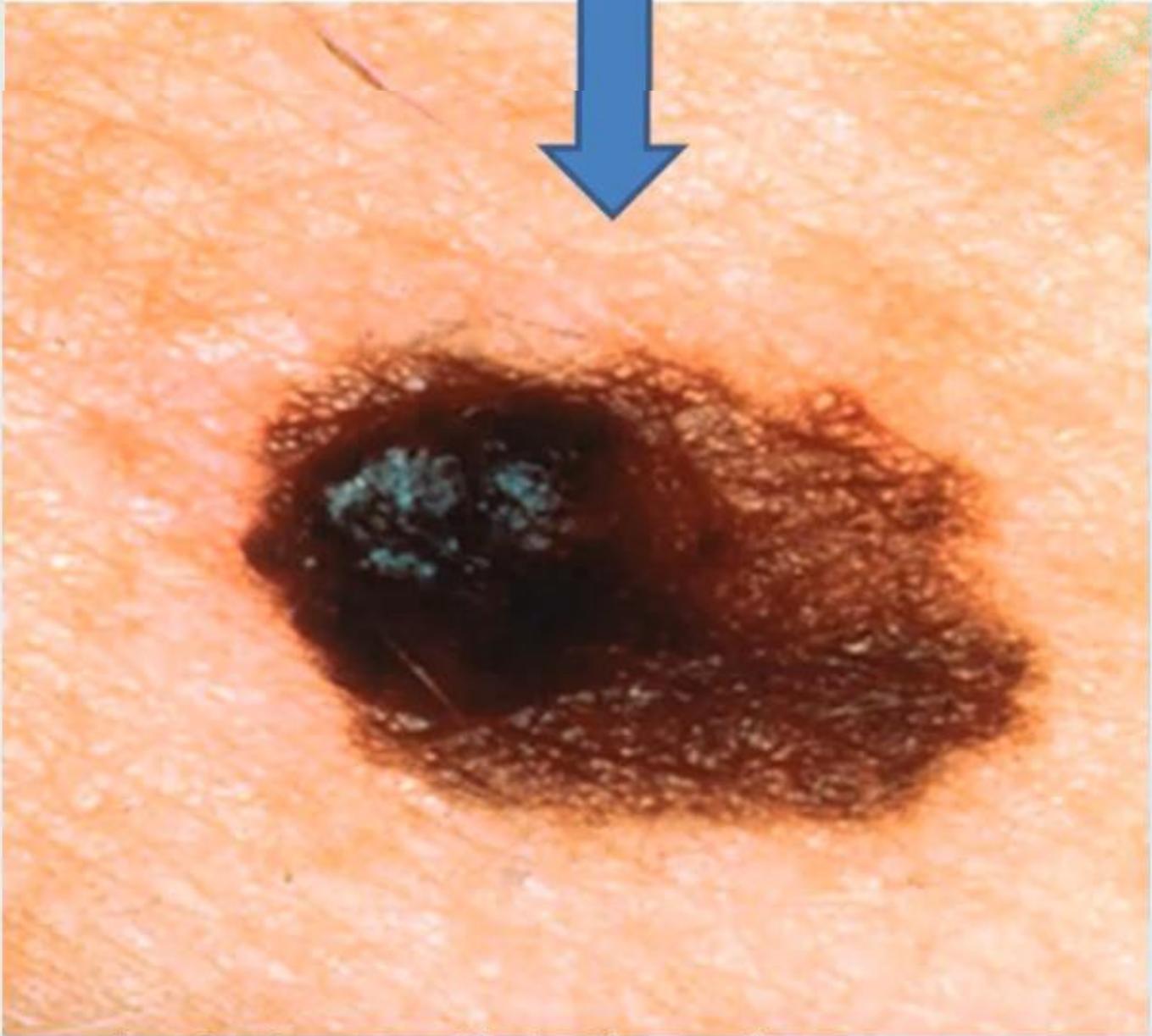 Dark Irregular Melanoma