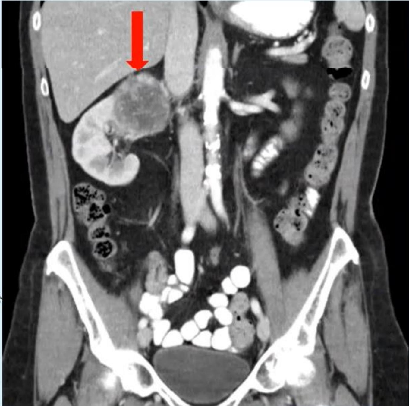 Coronal CT Scan Renal Mass