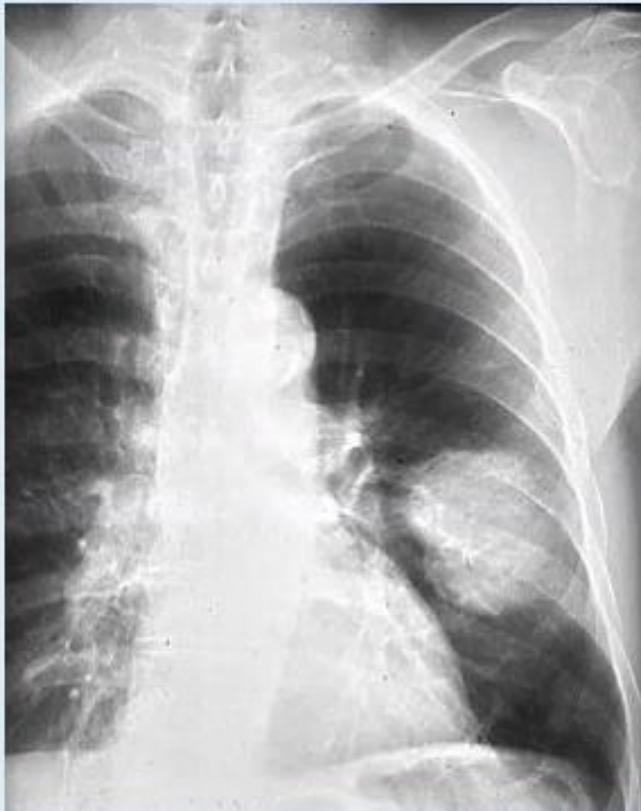 Solitary Lung Mass Chest X-Ray