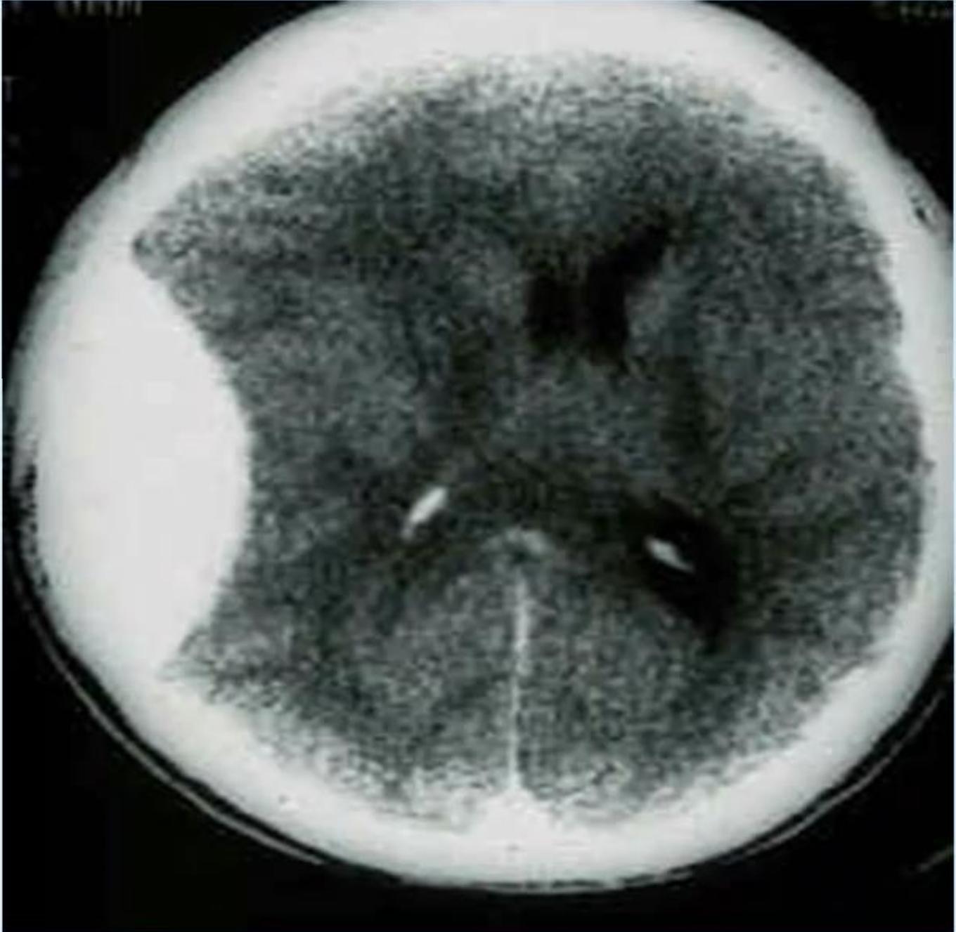 Axial Brain CT Epidural Hematoma Left