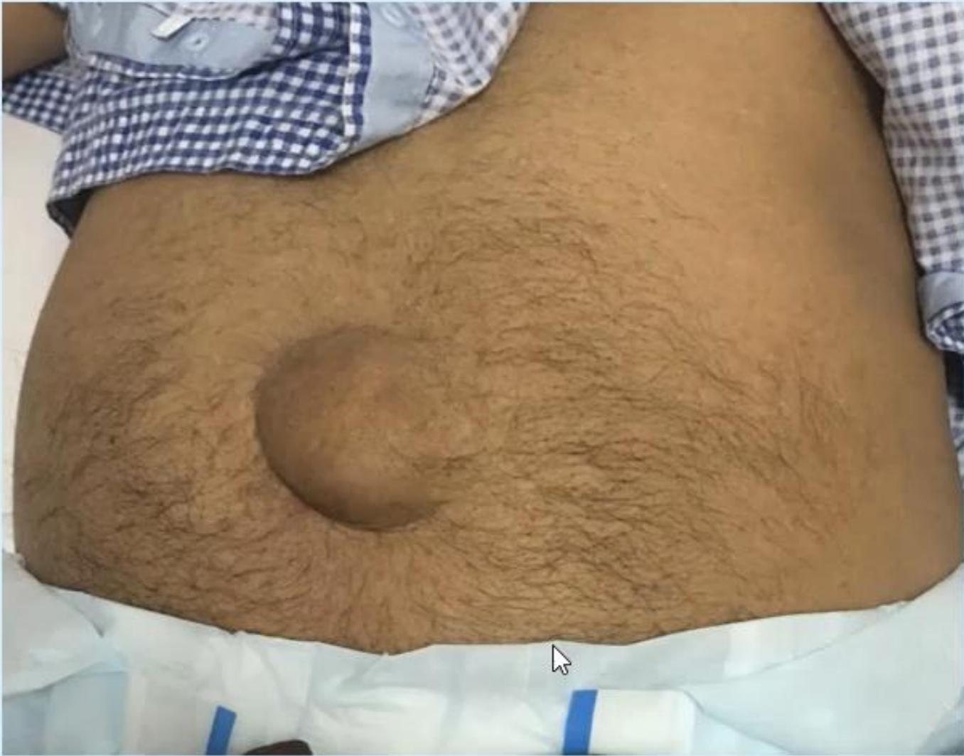 Paraumbilical Hernia Male Abdomen
