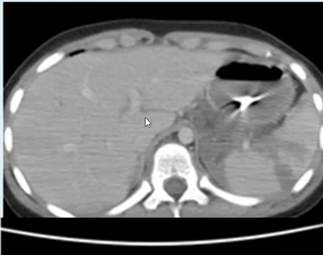 Axial CT Splenic Rupture