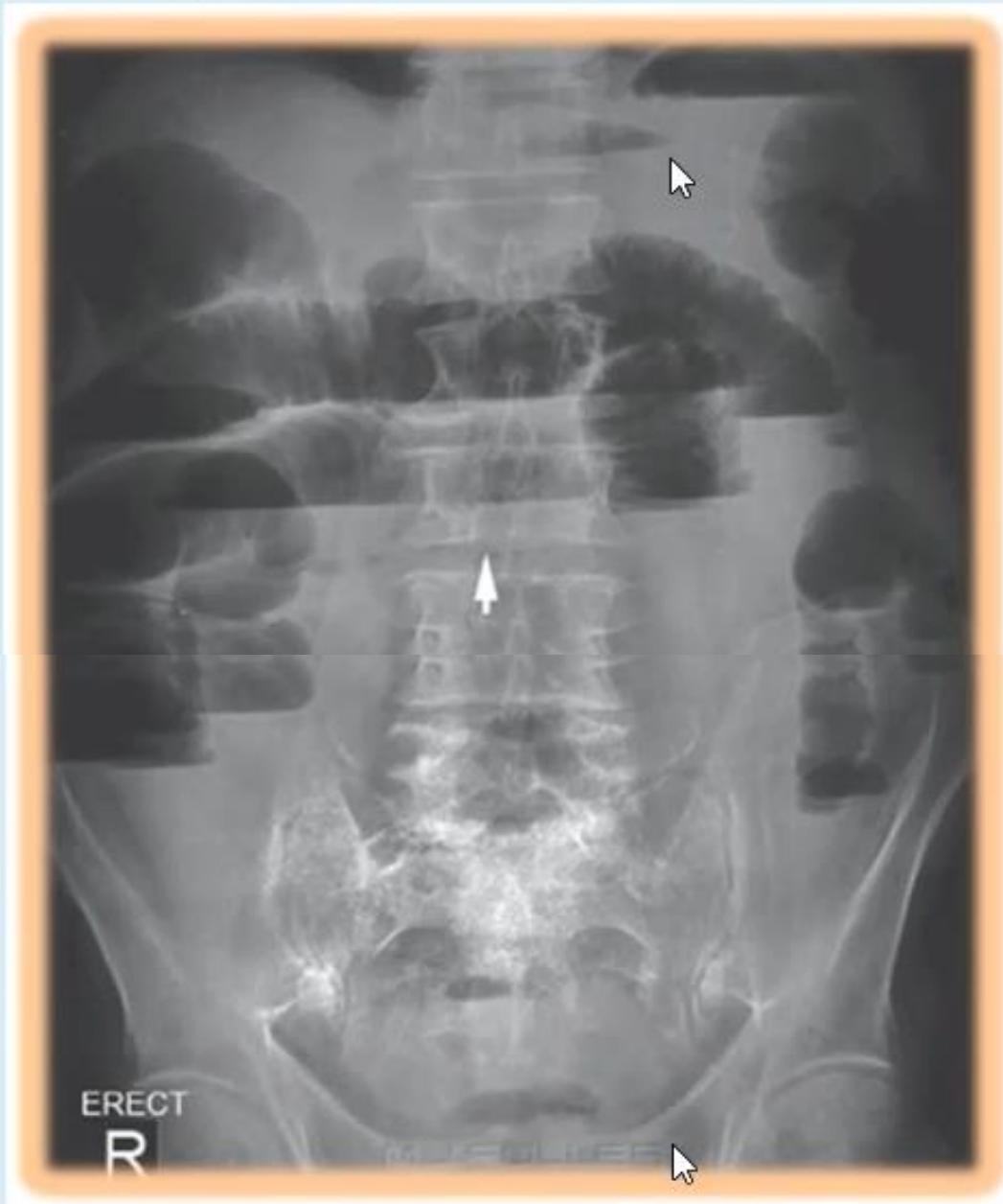 Abdominal X-Ray Small Bowel Obstruction