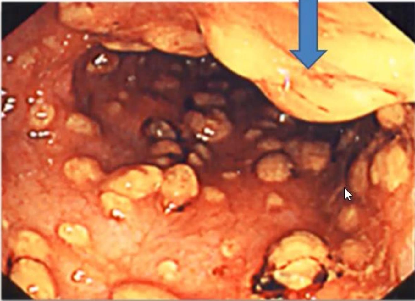 Pseudomembranous Colitis Sigmoidoscopy