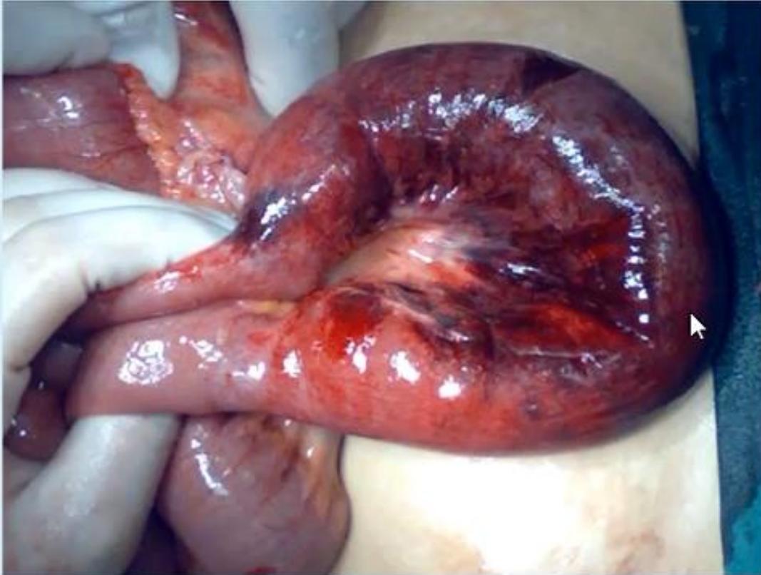 Laparotomy Finding Strangulated Bowel