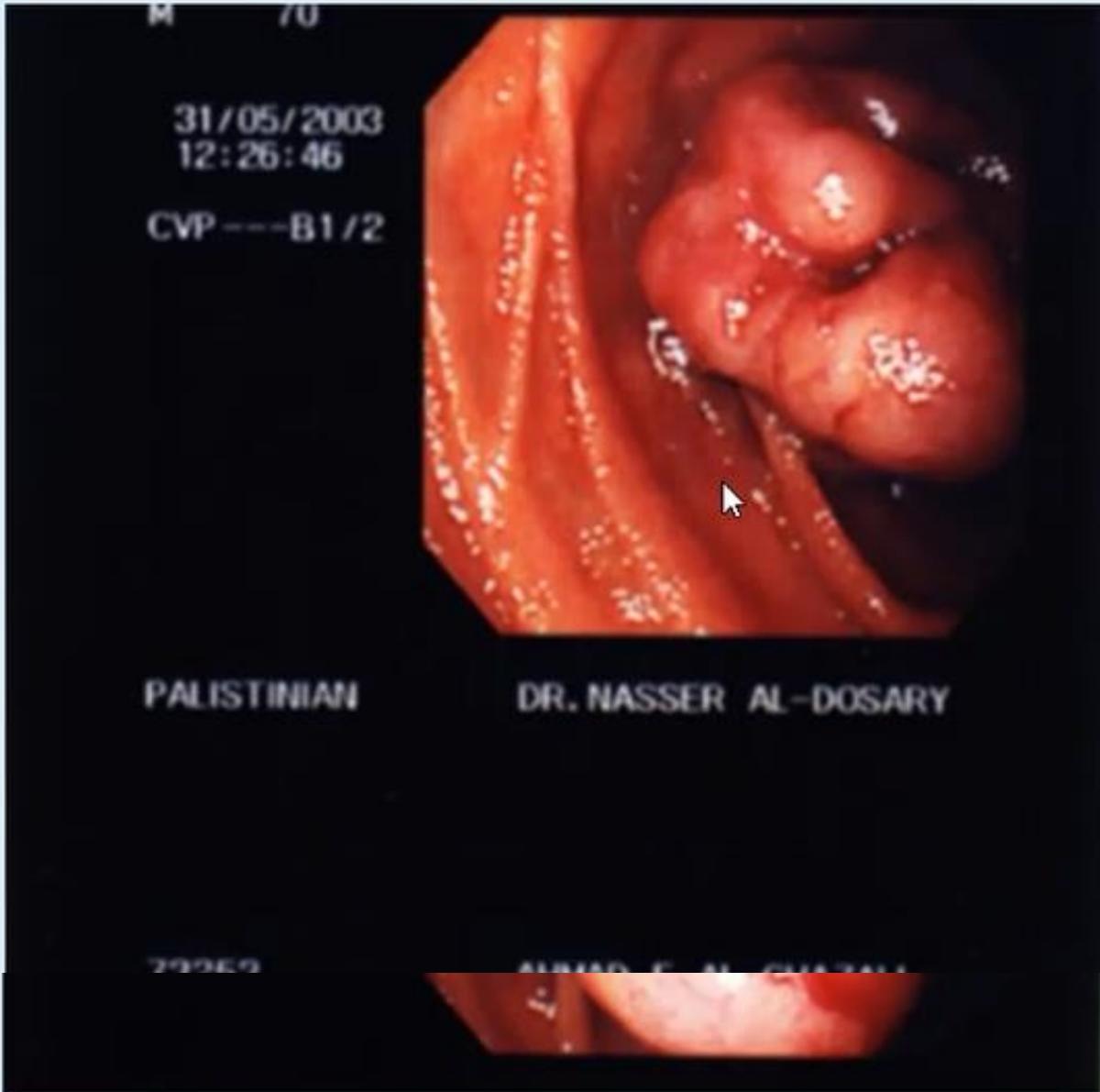 Upper GI Endoscopy Gastric Mass