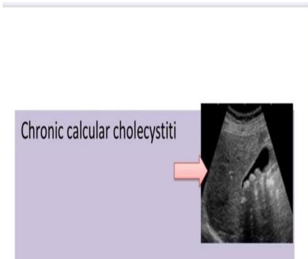 Chronic Calculous Cholecystitis Ultrasound