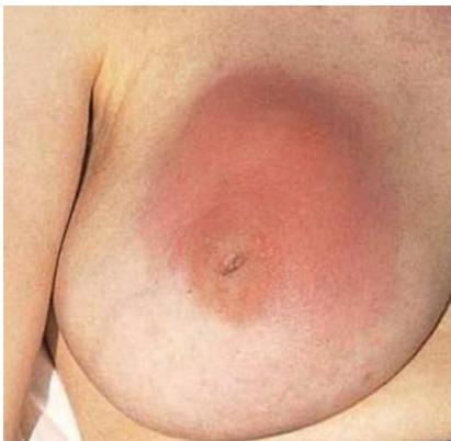 Breast Abscess Clinical Photograph