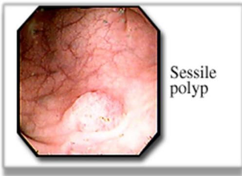 Endoscopic View Sessile Polyp