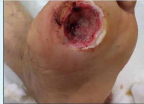 Diabetic Foot Ulcer Close-up