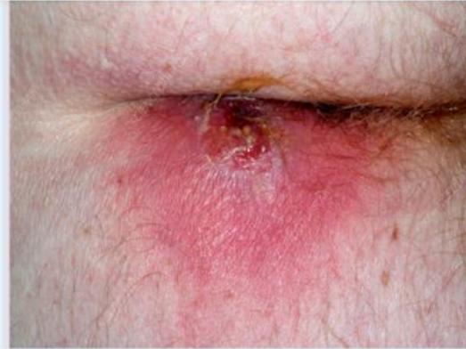 Perianal Abscess Male Patient