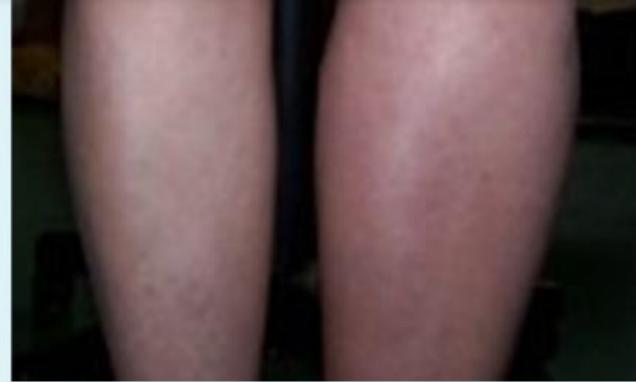 Asymmetric Lower Extremity Swelling DVT