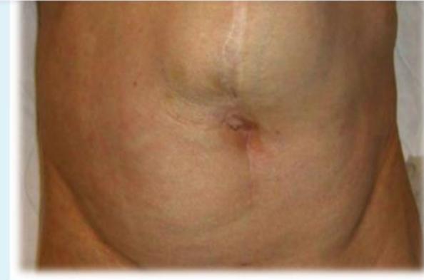 Surgical Scar with Incisional Hernia