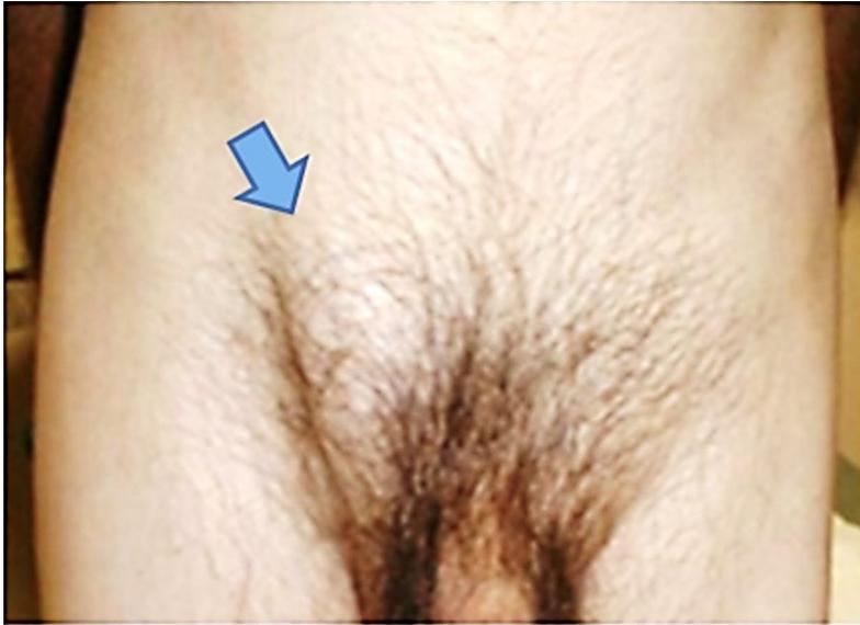Right Inguinal Swelling