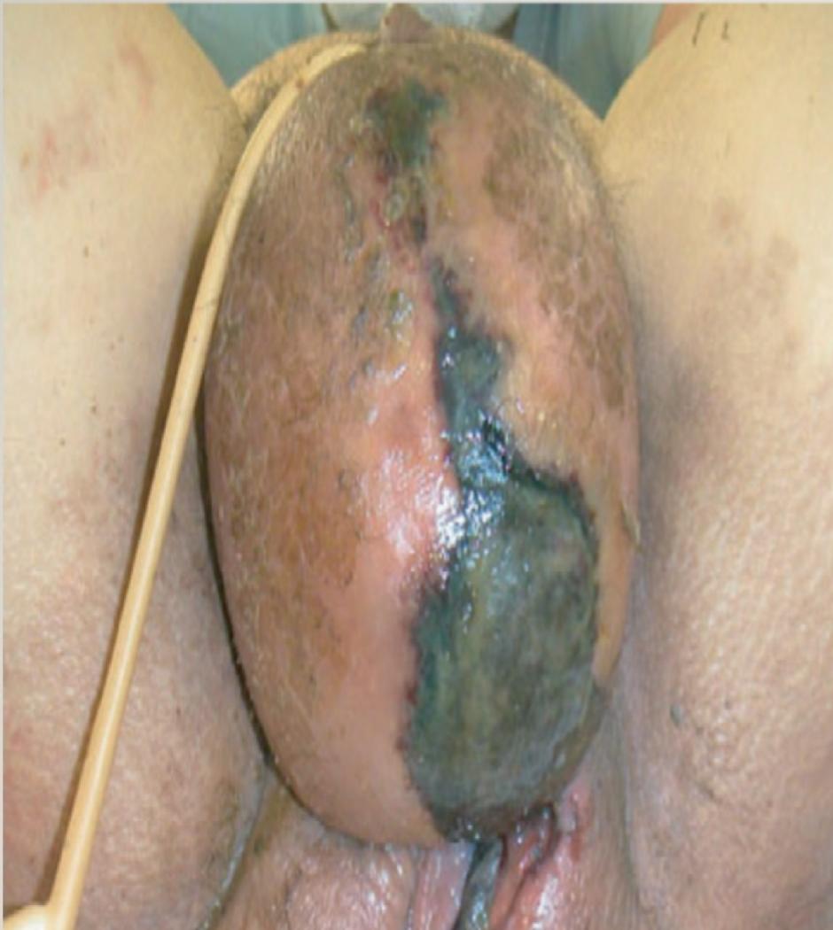 Fournier Gangrene Scrotum
