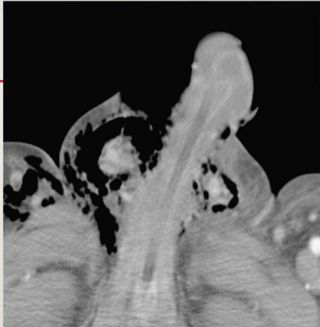 CT Scan Fournier Gangrene