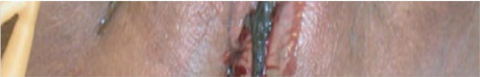 Surgical Incision